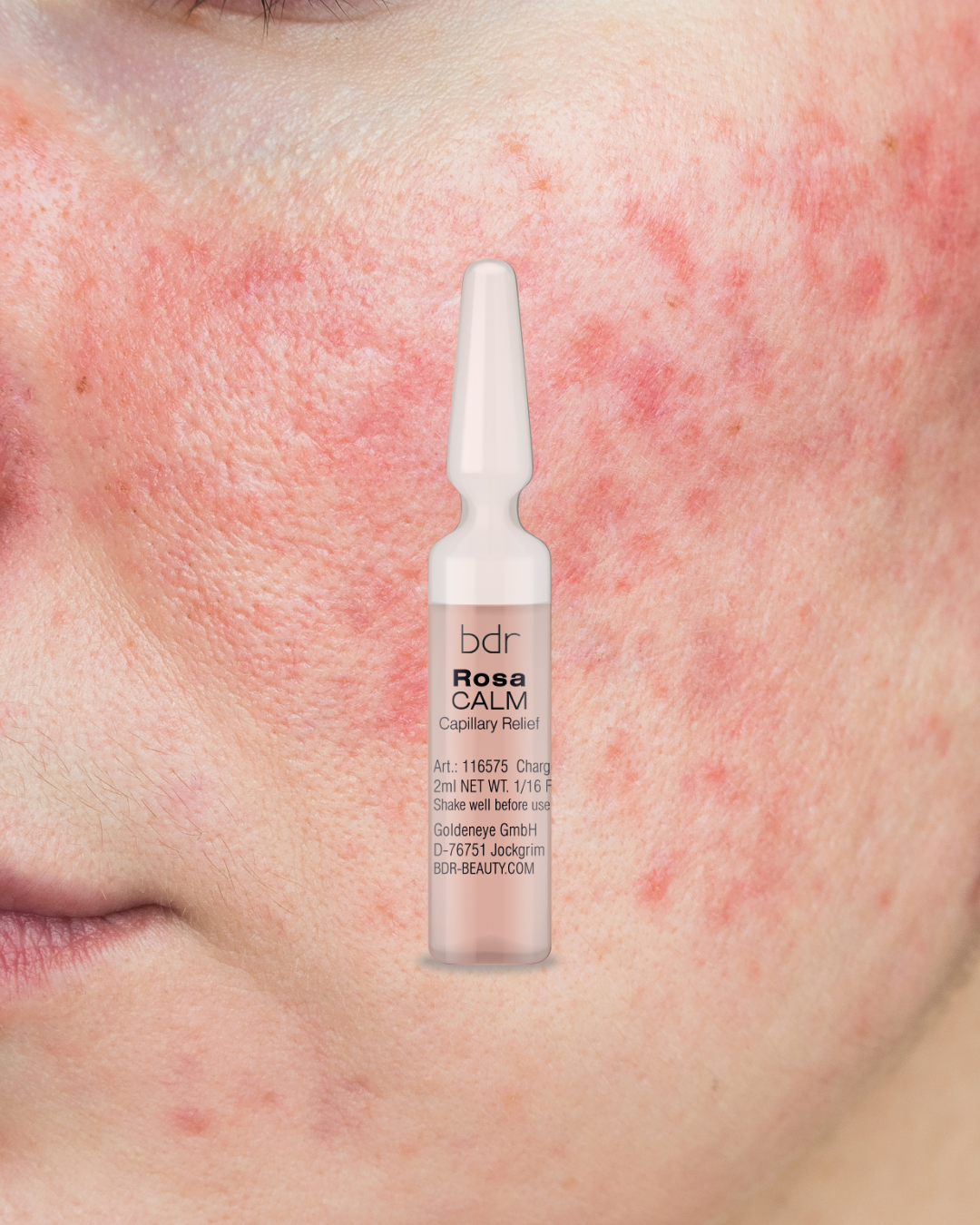 Caring for Rosacea-Prone Skin: Why Understanding the Skin Comes First